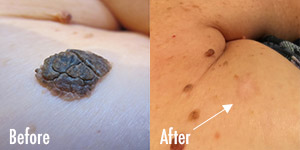 Seborrheic Keratosis Electrocautery